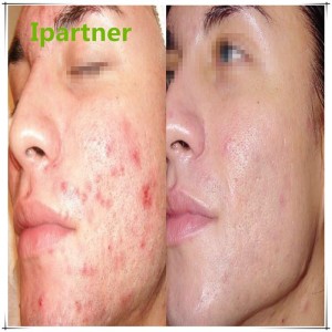 ขายร้อน Derma Roller สำหรับการดูแลผิว